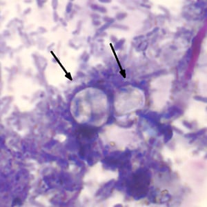 Figure B: Two oocysts of <em>C. cayetanensis</em> stained with modified acid-fast stain. Both oocysts failed to take up the carbol fuschin stain. Image courtesy of the Arizona State Public Health Laboratory.