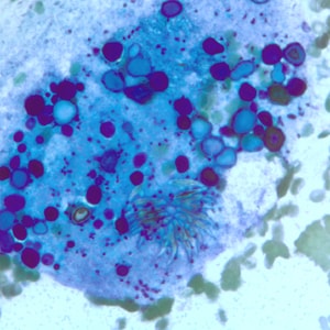 Figure E: Degenerating protoscolex from a liver cyst, stained with PAP. Notice the conspicuous calcareous corpuscles, characteristic of cestode infections.