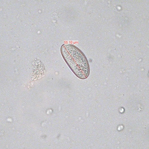 Figure D: Egg of <em>E. vermicularis</em> teased from an adult worm recovered from a colonoscopy. Image contributed by the South Carolina Department of Health and Environmental Control, Bureau of Laboratories.