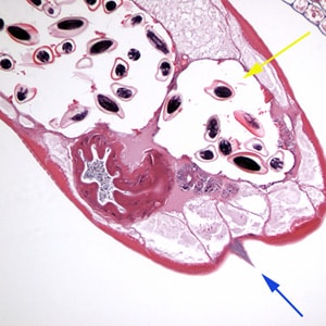 Figure C: Cross section of an adult female <em>E. vermicularis</em> stained with H&E, recovered during a colonoscopy. Note the prominent alae (blue arrow) and the presence of eggs (yellow arrow). Image contributed by Sheboygan Memorial Hospital, Wisconsin.