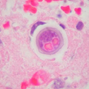 Figure I: Cyst of <em>B. mandrillaris</em> in brain tissue, stained with H&E. Image courtesy of Cook Children’s Hospital, Fort Worth, Texas.