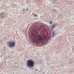 Figure G: Cyst of <em>B. mandrillaris</em> in brain tissue, stained with H&E. Image courtesy of the University of Kentucky Hospital, Lexington, Kentucky.