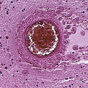 Figure E: Cyst of <em>B. mandrillaris</em> in brain tissue, stained with hematoxylin and eosin (H&E).