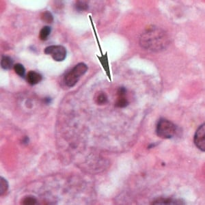 Figure G: A single trophozoite (black arrow) of <em>B. mandrillaris</em> in brain tissue, stained with H&E.