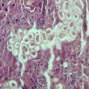 Figure A: Eggs of <em>C. hepatica</em> in liver stained with hematoxylin and eosin (H&E).