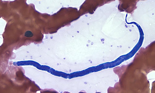 A hospital submitted blood films to CDC's reference laboratory for identification of the microfilariae that were seen on the films. The object in Figure A was seen on a Wright-Giemsa stained blood film and measured approximately 180 µm. 