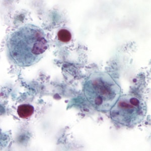 Images from a trichrome stained fecal smear were submitted to DPDx telediagnosis assistance from a public health laboratory. Parasites were suspected and further confirmation was needed. The patient was a 32-year-old male who had diarrhea; no travel history was known. 