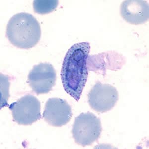A patient was seen at a hospital in Rwanda with headache, fever, and chills. A thin blood smear was made, stained with Giemsa, and examined.