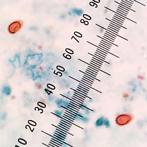 A patient had two stool specimens submitted for ova and parasite (O & P) examination. Smears were made, stained with trichrome, and examined.  Eosinophils and Charcot-Leyden crystals were observed in both specimens.