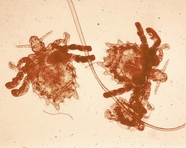Phthirus pubis, adults and nymphs.