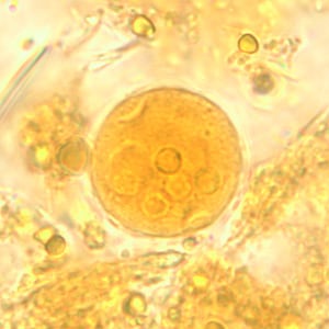 Figure E: Cyst of <em>E. coli</em> in a concentrated wet mount stained with iodine. Five nuclei are visible in this focal plane.