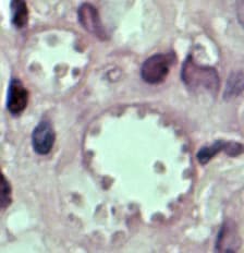 Figure B: <em>Leishmania mexicana</em> in a biopsy specimen from a skin lesion stained with H&E. The amastigotes are lining the walls of two vacuoles, a typical arrangement. The species identification was derived from culture followed by isoenzyme analysis.