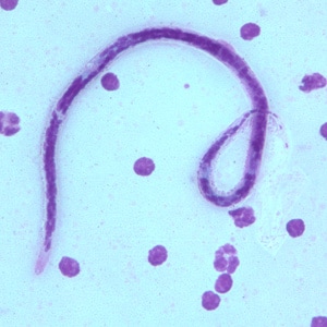 Figure B: Microfilaria of <em>B. timori</em> in a thick blood smear from a patient from Indonesia, stained with Giemsa and captured at 500x oil magnification. Image from a specimen courtesy of Dr. Thomas C. Orihel, Tulane University, New Orleans, LA.