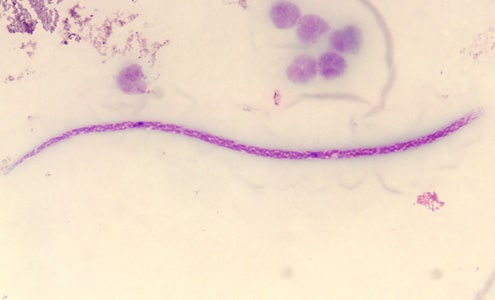 Figure F: Microfilaria of <em>M. perstans</em> in a thick blood smear stained with Giemsa. Image courtesy of the Parasitology Department, Public Health Lab, Ontario Agency for Health Protection and Promotion, Canada.
