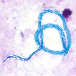 Figure B: Microfilaria of <em>M. perstans</em> in a thick blood smear stained with Giemsa, from a patient from Cameroon.