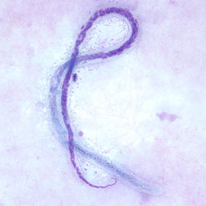 Figure D: Microfilaria of <em>M. ozzardi</em> in a thick blood smear, stained with Giemsa. Note the hook-like end to the tail in this figure.