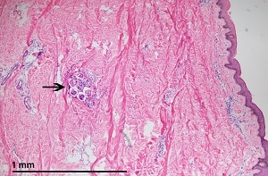 Figure A: Coiled female <em>M. streptocerca</em> (arrow) found ~1.5 mm below the surface of the skin, hematoxylin and eosin stained.  
