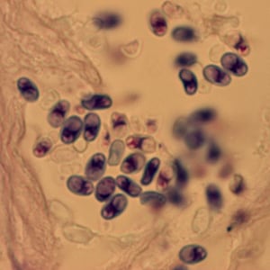 Figure A: Microsporidia spores from a corneal section, stained with Giemsa.