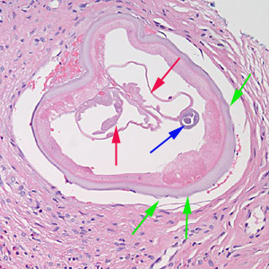 Figure E: Cross-section of an adult female <em>Onchocerca</em> sp. from the biopsy of a scalp nodule from a patient from Liberia. Note the presence of the intestine (blue arrow), uterine tubes (red arrows) and some cuticular nodules (green arrows). Also notice the weak musculature under the thick cuticle. Image courtesy of Drs. Philip LeBoit and Paul Borbeau.