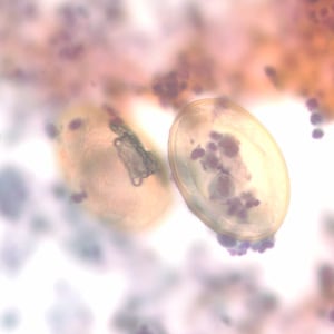 Figure D: Eggs of <em>P. kellicotti</em> in a Pap-stained bronchial alveolar lavage (BAL) specimen at 400x magnification. Image courtesy of Dr. Gary Procop.