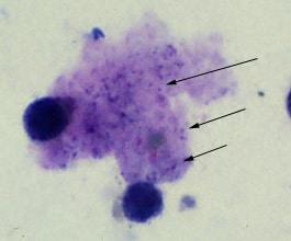 Figure A: Trophozoites of <em>P. jirovecii</em> in a bronchoalveolar lavage (BAL) specimen from an AIDS patient, stained with Giemsa.