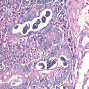 Figure B: Sections of <em>S. stercoralis</em> from a duodenal biopsy specimen, stained with H&E. Although strongyloidiasis could not be confirmed based on microscopy alone, this case was confirmed using molecular methods (PCR). Image taken at 200x magnification.