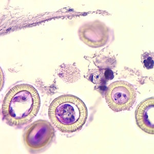 Figure C: Higher magnification of the image in Figure B, showing a close-up of the eggs. Note the characteristic striations, typical for the taeniids. Not visible in these images are the hooks commonly seen in cestode eggs. Hooks do not stain with H&E but are refractile and are visible with fine focusing of the microscope