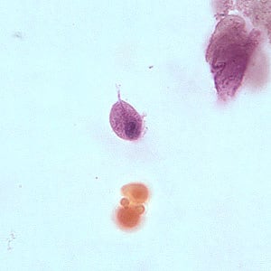 Figure D: Trophozoite of <em>T. vaginalis</em> in a vaginal smear, stained with Giemsa.