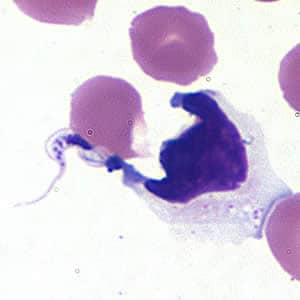 Figure A: <em>Trypanosoma cruzi</em> trypomastigote in cerebrospinal fluid (CSF) stained with Giemsa.