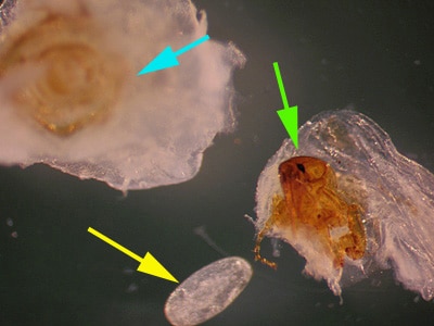 Figure A: <em>Tunga penetrans</em> removed from a lesion on the bottom of the foot of a patient who traveled to Africa. The bulk of the lesion and the posterior part of the flea are marked with a blue arrow. The anterior end of the flea, showing the head, mouthparts and forelegs, is marked with a green arrow. Note the lack of pronotal and genal combs. A single egg (yellow arrow), is also shown.