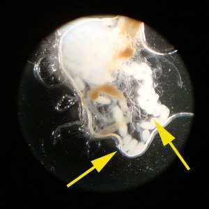Figure B: Eggs of <em>T. penetrans</em> liberated from the lesion on the second toe of a patient who traveled to Guyana. Image courtesy of Spectrum Health, Grand Rapids, MI.