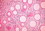 Thumbnail of Histology of rhinosporidiosis. A formaldehyde-fixed section of human nasal polyp was stained with Periodic acid-Schiff (PAS) and visualized by bright-field microscopy at 400X magnification. The thick walls of immature R. seeberi trophocytes stain with PAS (pink), and the spherical organisms are surrounded by inflammatory cells.