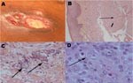 Thumbnail of A) Ulcerated, violaceous plaque on the trunk of the patient with undermined infiltrated peripheral walls. B) Section of the lesion in A showing diffuse dermal-hypodermal necrosis with neutrophil infiltration (thin arrow) and sparse histiocytelike cells (thick arrow) (hematoxylin and eosin–stained, magnification ×10). C) Surgical skin biopsy specimen showing amebic cysts (arrows) in the dermal-hypodermal junction (hematoxylin and eosin–stained, magnification ×20). D) Surgical skin biopsy specimen showing intravascular amebic trophozoite (arrow) characterized by acanthopodia, cytoplasmic vacuoles, and a prominent nucleolus (hematoxylin and eosin–stained, magnification ×40).