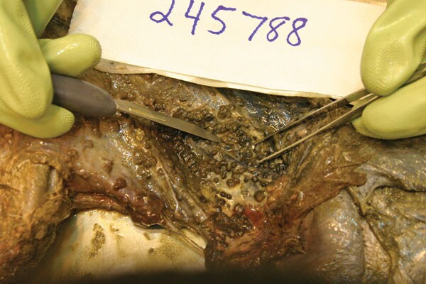 Photo of the chest cavity of a deer shot by patient 2; the deer was retrieved after being buried for 9 weeks. The photo shows the classical nodular lesions of Mycobacterium bovis infection. Photo: J.S. Fierke, D.J. O’Brien, S.M. Schmitt, Wildlife Disease Laboratory, Michigan Department of Natural Resources.