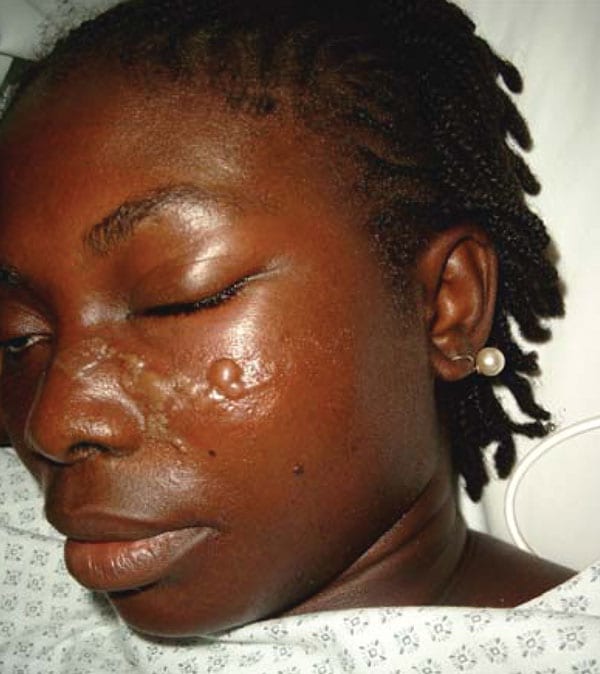 Romaña sign. Photo of female patient from French Guiana who lives in a metropolitan area of France. She had returned to Maripassoula to visit her parents during the holidays between July 13, 2004, and September 3, 2004. When the patient sought treatment on September 3, 2004, she had fever and unilateral periorbital edema.
