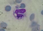 Thumbnail of Direct examination of bone marrow smear. Intracytoplasmic Histoplasma capsulatum var. capsulatum.
