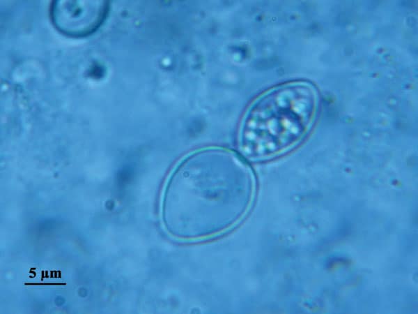 Direct examination of sputum fluid showing Histoplasma capsulatum var. duboisii.