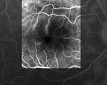 Thumbnail of Fluorescein angiograph of the right eye of the patient showing retinal occlusive vasculitis with arteriolar leakage at late phase.
