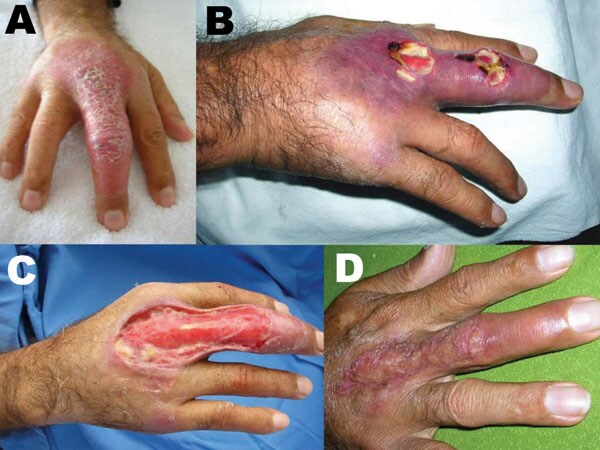 Patient 8. A) Nonulcerative edematous lesion on the right middle finger as first seen; B) ulcerated lesions on the right middle finger ≈4 weeks later; C) extensive debridement, 5.5 weeks after first seen; D) cured lesion 5 months after first seen, 1 month after autologous skin graft.