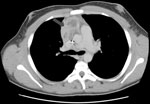 Thumbnail of Computed tomographic scan of thorax showing extension of infection with Aspergillus viridinutans into mediastinal structures (arrow).