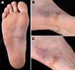 Thumbnail of Right foot of a patient from Brittany, France, with a hookworm-related cutaneous larva migrans, showing an elevated serpiginous lesion on the sole of the foot (panels A, B) and ulcerative lesions at the origin of the lesions on the lateral side of the foot (panel C).