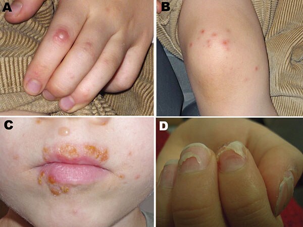 Vesicular eruptions in A) hand, B) foot, and C) mouth of a 6.5-year-old boy from Turku, Finland, with coxsackievirus (CV) A6 infection. Several of his fingernails shed 2 months after the pictures were taken. D) Onychomadesis in a 10-year-old boy from Seinäjoki, Finland, 2 months after hand, foot and mouth disease with CVA6 infection. Photographs courtesy of H. Kujari (A–C) and M. Linna (D).