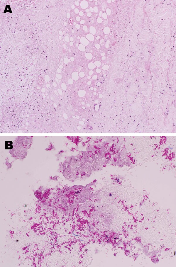 Histologic analysis showing necrosis of subcutaneous fat and deep dermal tissue of the patient. A) Noninflammatory infarction-like necrosis related to cytopathic effect of the mycolactone toxin secreted by Mycobacterium ulcerans. B) Abundant mycobacteria within the necrosis.