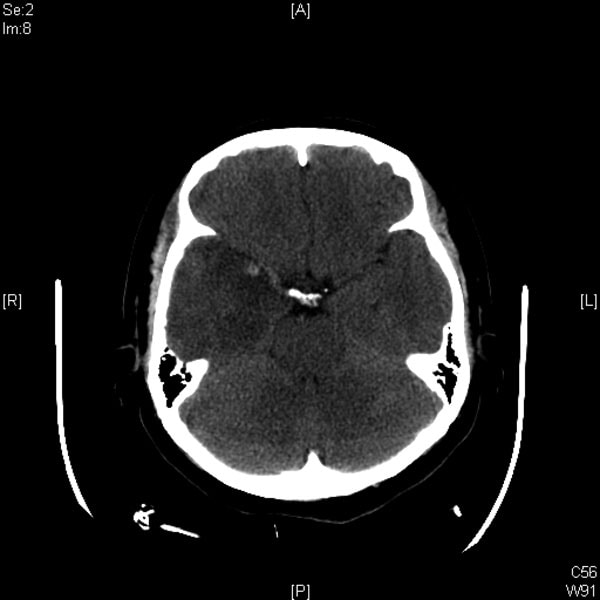Computed tomography scan showing hemorrhage in edematous part of brain of patient with herpes simplex virus encephalitis, day 5 of hospitalization.