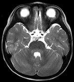 Thumbnail of Axial T2-weighted slice of brain by magnetic resonance imaging, showing hyperintensity lesions in the pons and cerebellum around the fourth ventricle.