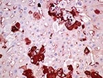 Thumbnail of Liver of affected rabbit with positive cytoplasmic immunohistochemical labeling in hepatocytes against rabbit hemorrhagic disease virus capsid. Original magnification ×400.