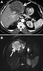 Thumbnail of Computed tomography (A) and magnetic resonance (B) images of the liver of a 72-year-old man from French Guiana with polycystic echinococcosis affecting the left side of the liver. White arrows indicate the multicystic liver lesion.
