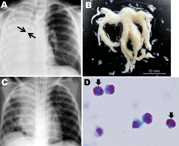 A) Chest radiograph obtained at hospital admission from a child infected with influenza subtype H1N1 virus. The image shows atelectasis of the right lung and hyperinflation of the left lung; arrows indicate obstruction of the right main bronchus. B) Macroscopic bronchial casts extracted by intratracheal suction. C) Chest radiograph obtained on hospital day 2, indicating partial resolution of atelectasis of the right lower lobe. D) Light micrograph of casts, characterized by predominant eosinophi
