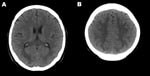 Thumbnail of Computed tomography images of the brain of an adult patient with pandemic (H1N1) 2009 virus infection and neurologic signs. A noncontrast study showed hypodense lesions in both occipital lobes (A) and in both upper parietal lobes (B).
