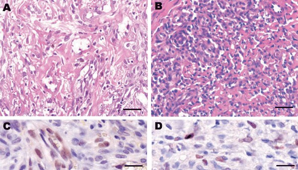 Histologic patterns of cutaneous Kaposi sarcoma (KS) associated with a human herpesvirus 8 (HHV-8) type E infection. Patient 1: A) The spindle cells were organized as bundles, forming vascular slit-like spaces containing erythrocytes. Some macrophages containing hemosiderin were observed (data not shown). Scale bar = 25 μm. C) Immunohistochemical testing showed a positive signal for HHV-8 infection (latent nuclear antigen [LANA-1]) and CD34 (data not shown). The Perls staining also gave highly p